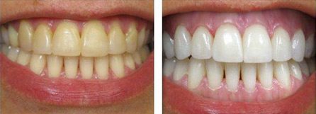 Before and After Bleaching