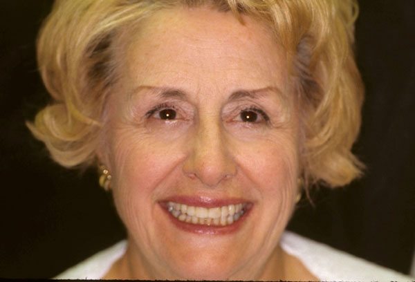 Before and After with Porcelain Veneers and Crowns