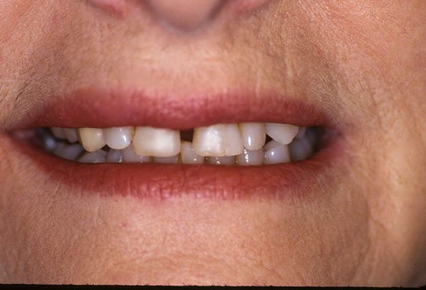 Before and After with Porcelain Veneers and Crowns