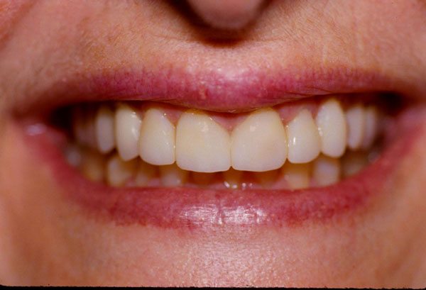 Before and After with Porcelain Veneers and Crowns
