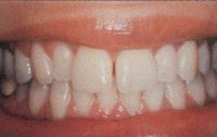 Fig. 14 Teeth that are under excessive force in vertical or lateral directions can be moved if the bone support is not strong enough