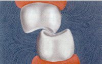 Fig. 18 Maxillary and mandibular molars contacting in excursive movement always have off-axis loading.
