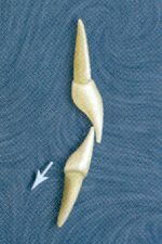 Fig. 20 Mandibular incisors tend to have mostly axial ompressive loads due to the direction of occlusal forces.