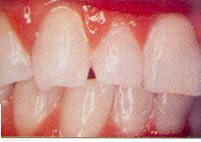 Fig. 4. This tooth was reported to be sensitive to heat and cold