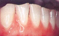 Fig. 6. This wear, based on the exact alignment of the maxillary and mandibular teeth, was caused by intense tooth grinding.