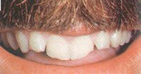 Fig. 7. These incisal edges were ground down so thin that they chipped off.