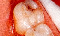 Fig. 9. This crack allowed micromovement of the segments and caused sharp pain on biting