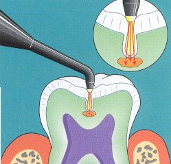 The Diagnodent diagnostic laser can get to the decay area.