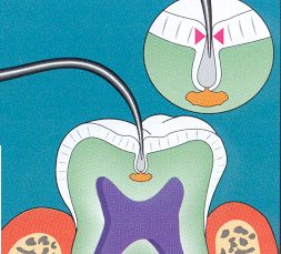 Dental pick can't get to decay