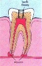 endodontic-treatment-2