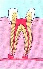 endodontic-treatment-3