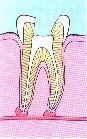 endodontic-treatment-4