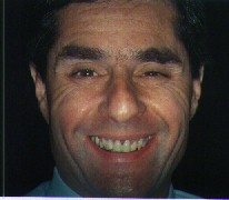 Before Treatment