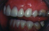 Left Side: After
