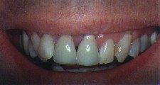 Before Treatment Smile