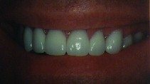 After Treatment Smile