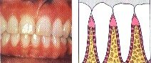 periodontal-disease-1