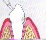 periodontal-disease-10