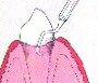 periodontal-disease-11