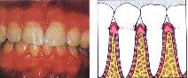 periodontal-disease-2