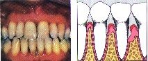 periodontal-disease-3