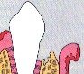 periodontal-disease-6