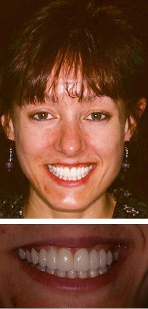 Before and After with Porcelain Veneers and Crowns