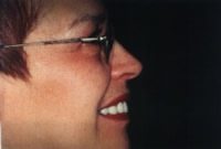Before and After with Porcelain Veneers and Crowns