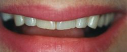 Before and After with Porcelain Veneers and Crowns