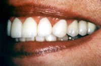 Before and After with Porcelain Veneers and Crowns