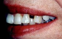 Before and After with Porcelain Veneers and Crowns