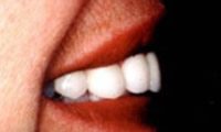 Before and After with Porcelain Veneers and Crowns