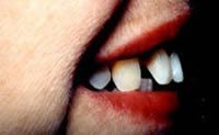 Before and After with Porcelain Veneers and Crowns