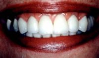 Before and After with Porcelain Veneers and Crowns