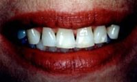 Before and After with Porcelain Veneers and Crowns