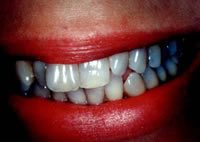 Before and After with Porcelain Veneers and Crowns
