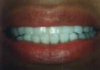 Before and After with Porcelain Veneers and Crowns
