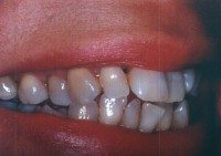 Before and After with Porcelain Veneers and Crowns