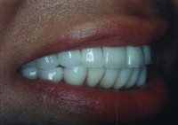 Before and After with Porcelain Veneers and Crowns