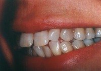 Before and After with Porcelain Veneers and Crowns