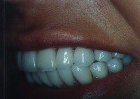 Before and After with Porcelain Veneers and Crowns