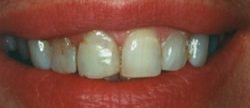 Before and After with Porcelain Veneers and Crowns