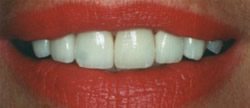 Before and After with Porcelain Veneers and Crowns