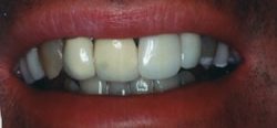 Before and After with Porcelain Veneers and Crowns