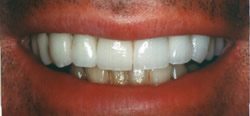 Before and After with Porcelain Veneers and Crowns
