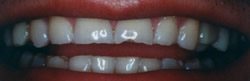 Before and After with Porcelain Veneers and Crowns