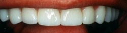 Before and After with Porcelain Veneers and Crowns