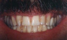 Before and After with Porcelain Veneers and Crowns