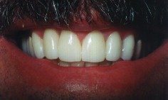 Before and After with Porcelain Veneers and Crowns