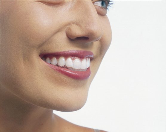 Invisalign